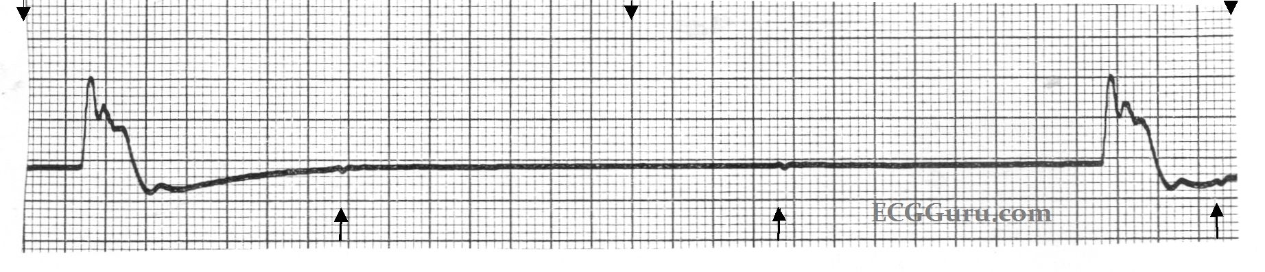 Ecg Basics Idioventricular Escape Rhythm Ecg Guru Instructor Resources